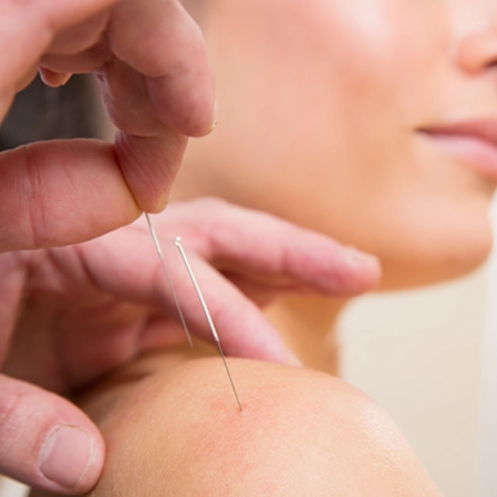 Chiropractic Omaha NE Woman Receiving Acupuncture